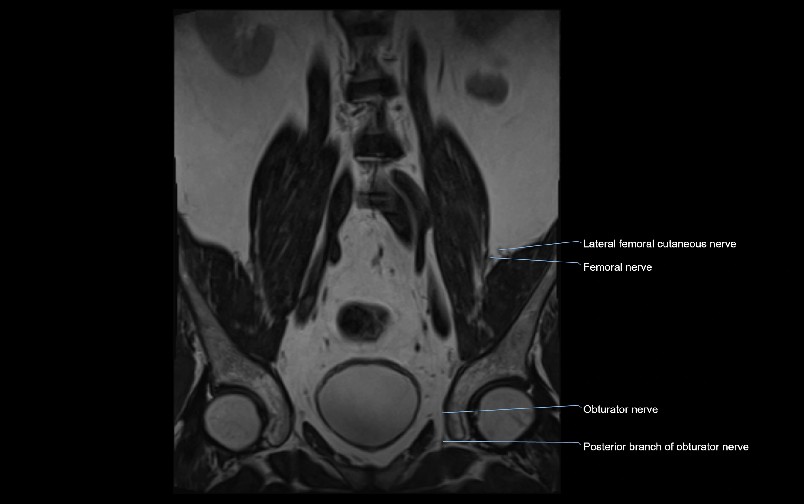 MR lumbosacral plexus cross sectional anatomy 3T  radiology  image-img-09001-00012.webp
